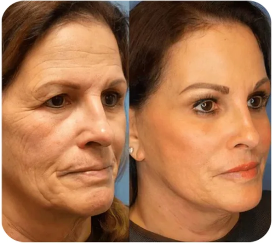 💖Instant Temporary Face Tightener